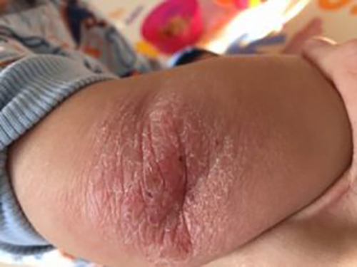 Fig. 5. Topical steroid skin damage. Note wrinkled, scaling, inflamed and thinned red skin.