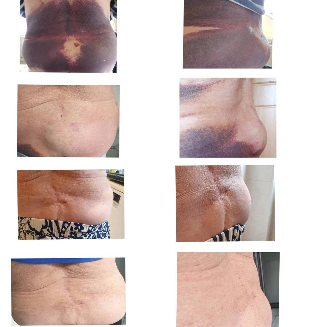 Fig. 1. Severe bruising recovers remarkably well just 2 months after regular application of wheatgrass extract on alternate days only. Without the extract, healing could have taken twice the time.